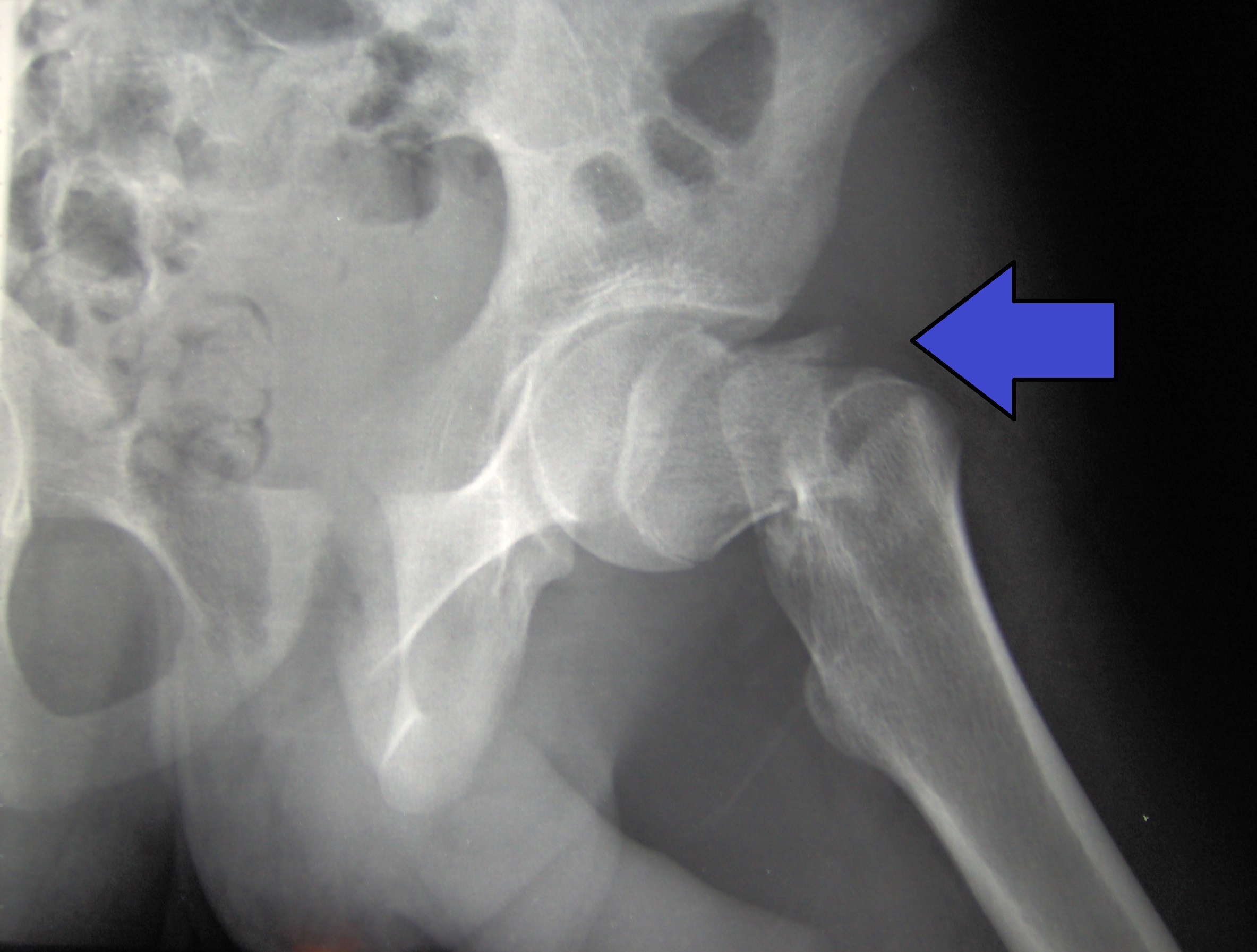 Hip Fracture Study