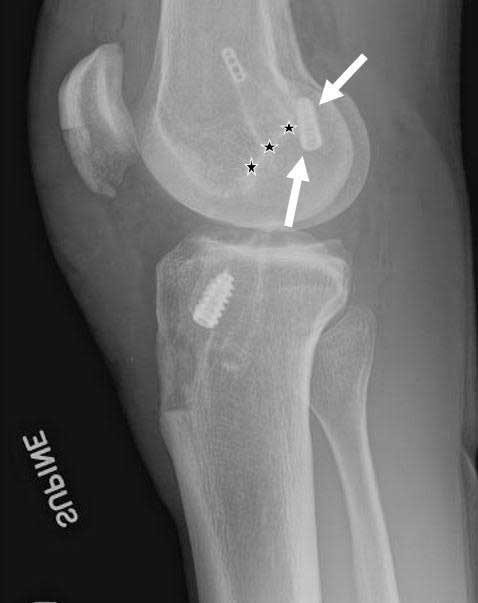 ACL Reconstruction Study